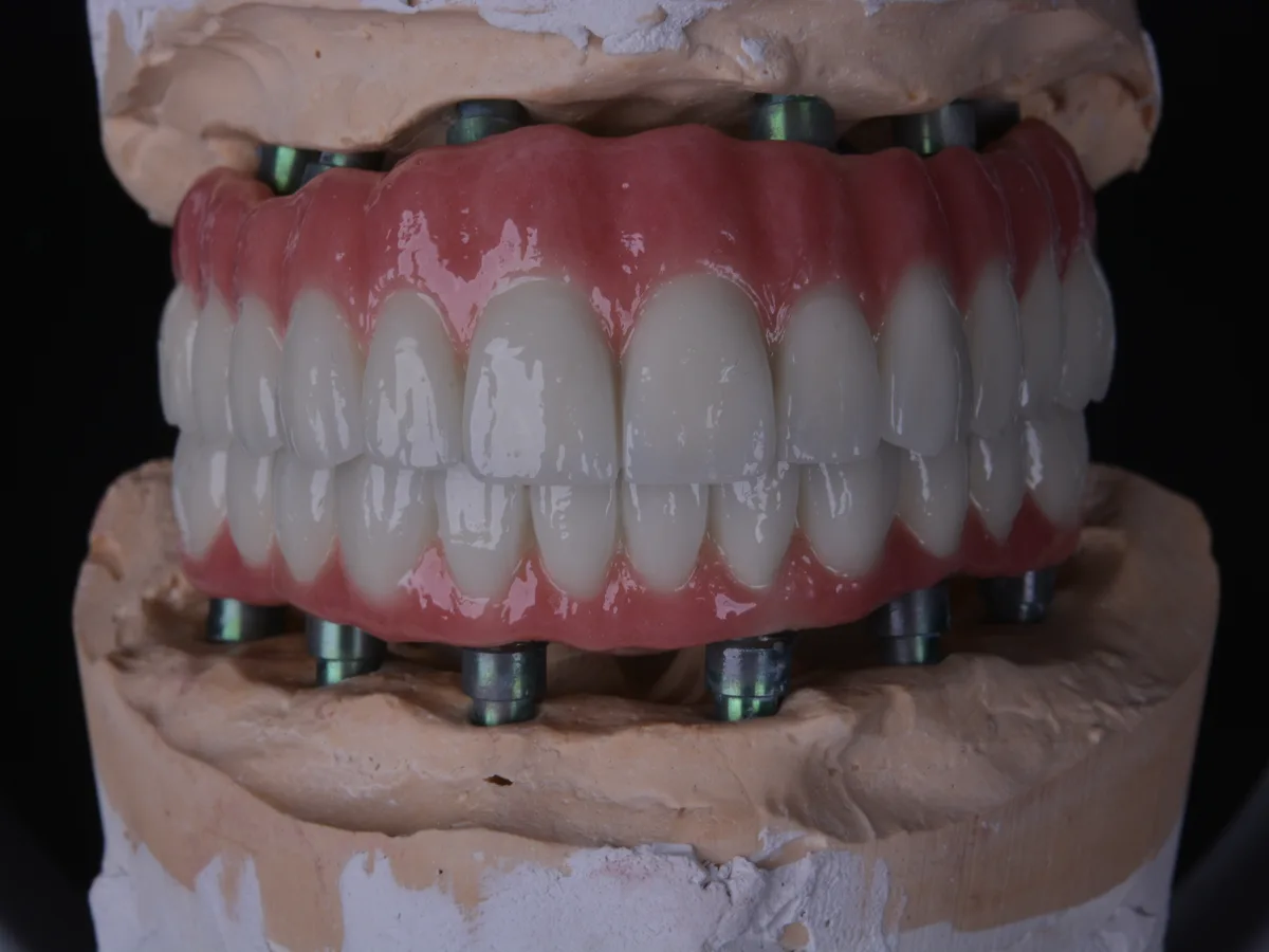 Diş hekiminin implant üstü protez modelini incelemesi