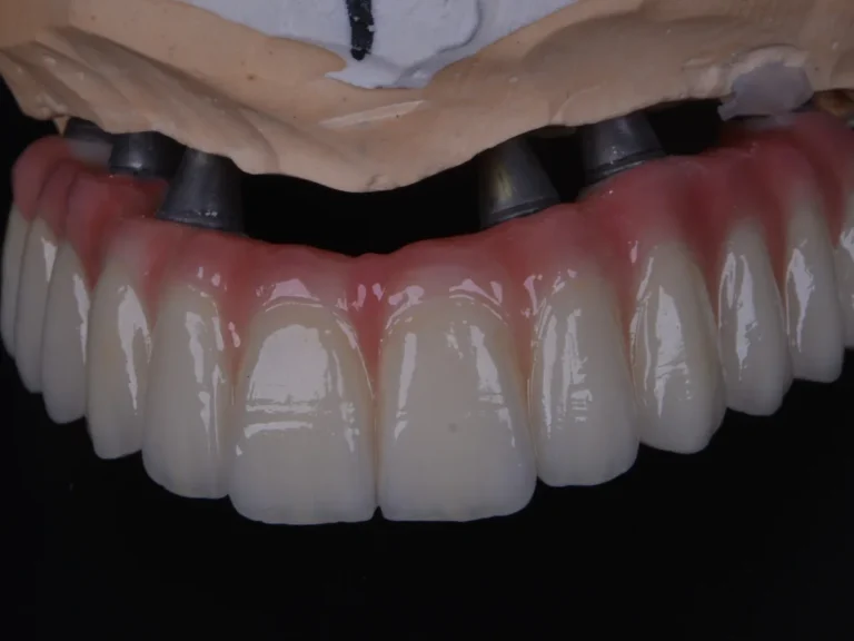 All-on-6 implant sisteminin diğer tam ark çözümleriyle karşılaştırılması