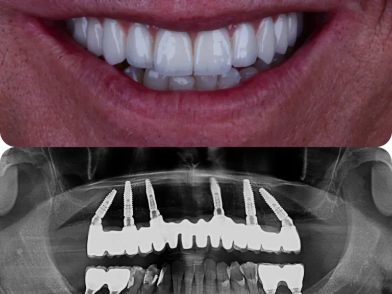 CityDent İstanbul'da all-on-6 implant tedavi sürecini gösteren görsel
