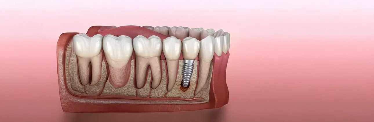 Çene kemiğiyle kaynaşmadığı için çıkarılması gereken diş implantını gösteren çizim