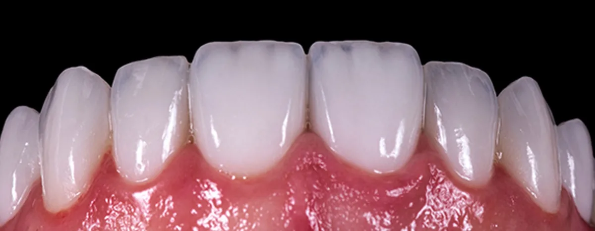 İstanbul zirkonyum kaplama