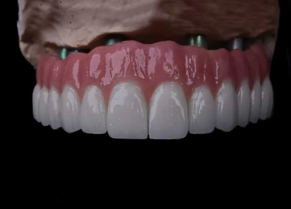 İstanbul All-on-4 implant tedavisi