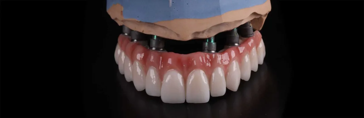 İstanbul All-on-6 implant tedavisi