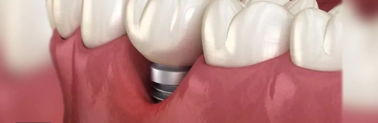 İmplant çevresinde diş eti çekilmesini gösteren çizim