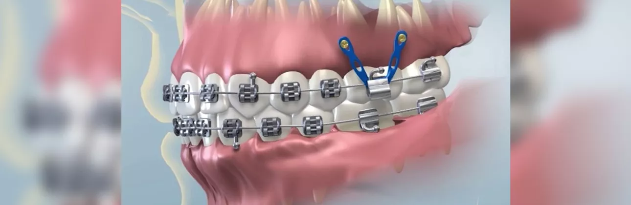 Ortodontik implant mini vidanın diş teline destek sağlamasını gösteren illüstrasyon
