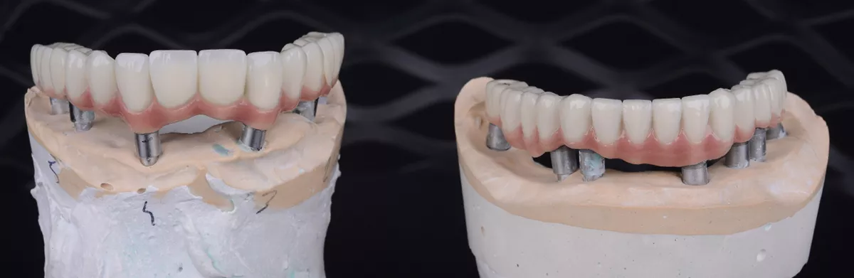 Tüm ağız implant tedavisi öncesi planlama görüntüsü, CityDent İstanbul