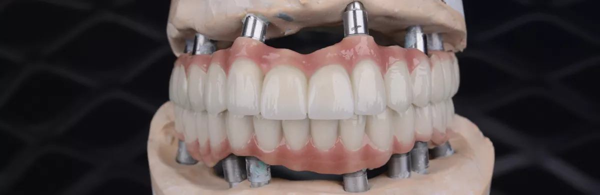All-on-4 ve All-on-6 yöntemleriyle tüm ağız implant yerleşimi