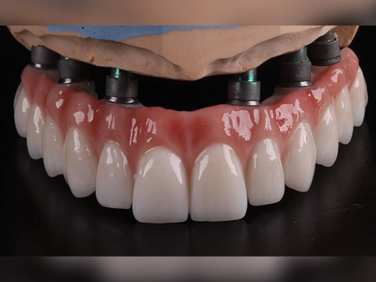 Zirkonya üst yapılı tüm ağız implant restorasyonu