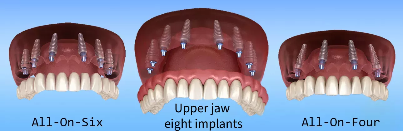 Dişsiz çenede planlanan implant sayısını gösteren çene şeması