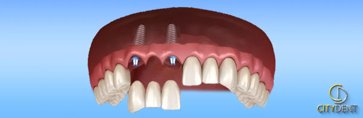 Alt ve üst çenede implant yerleşimini gösteren diş modeli