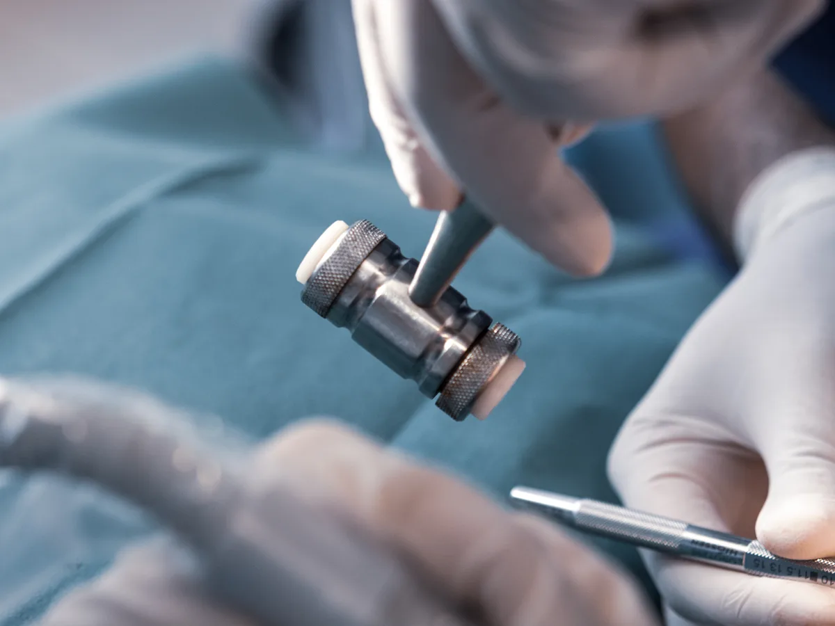 Tek aşamalı implant uygulamasında implantın çene kemiğine yerleştirilmesini gösteren model