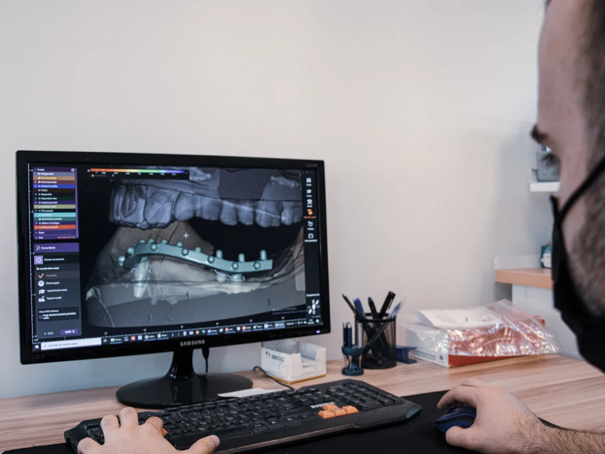 Diş implantının çene kemiğine yerleştirilmesini gösteren görsel
