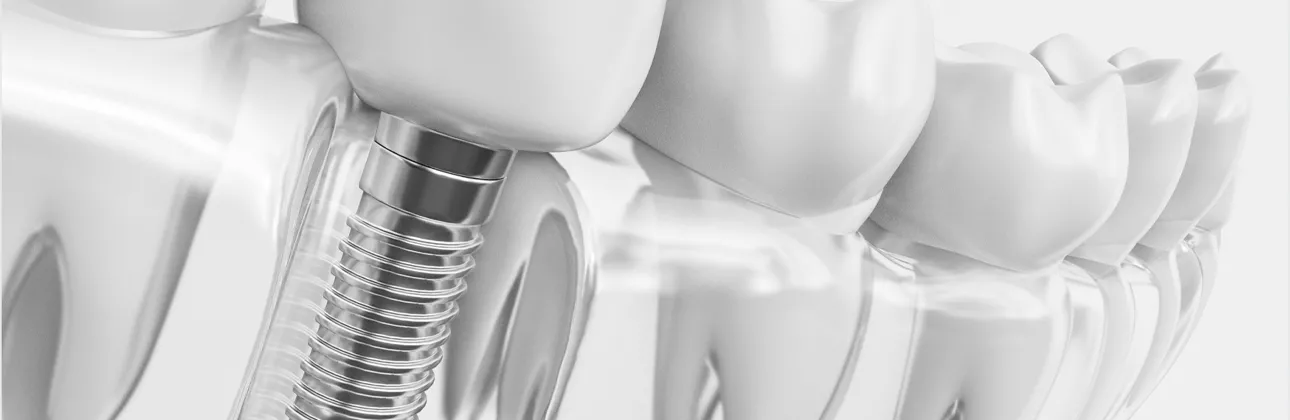 Steril ambalajında bekleyen orijinal diş implantı