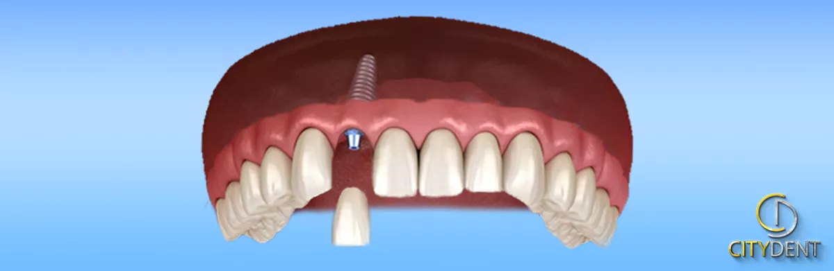 Tek diş eksikliğinde yerleştirilen implant ve üzerine takılan kron